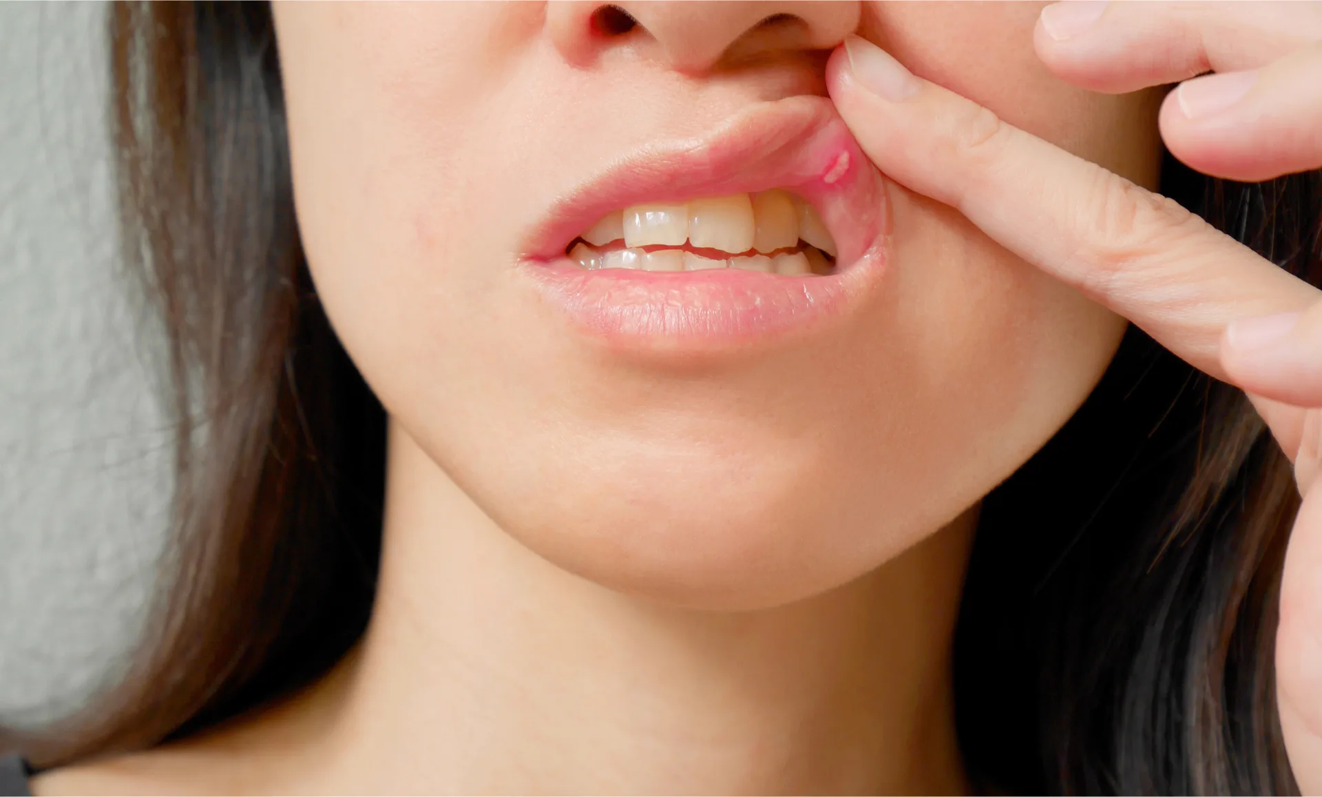 Canker Sores and Cold Sores