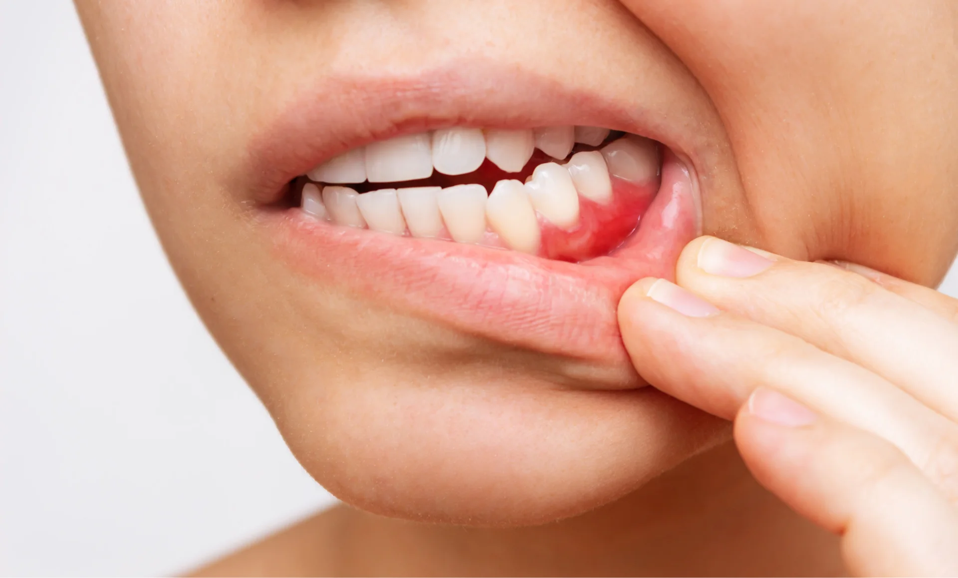 Gum Disease
