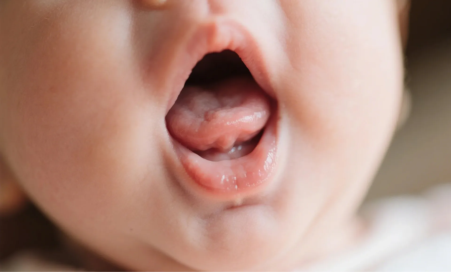 Tongue Tie